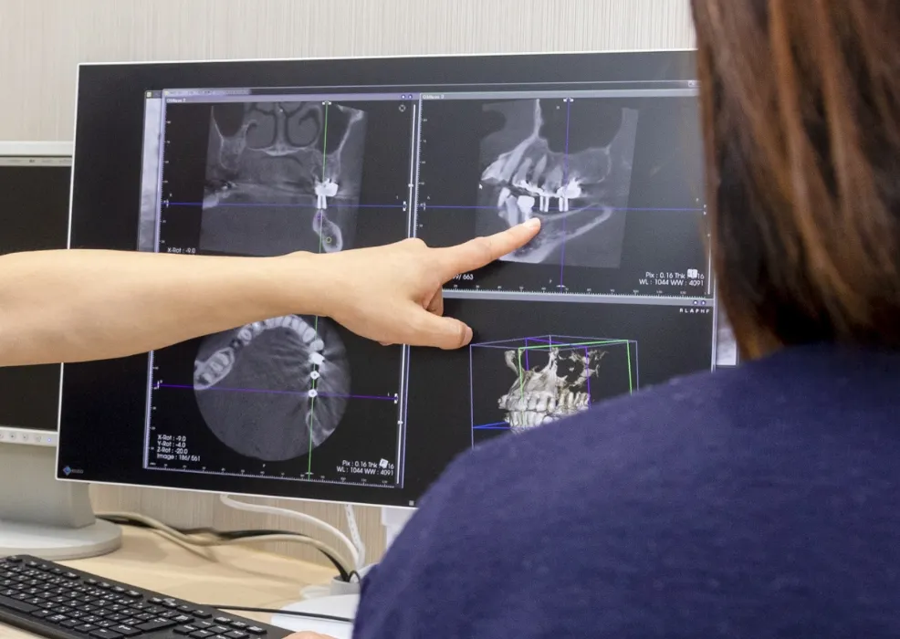 インプラント治療